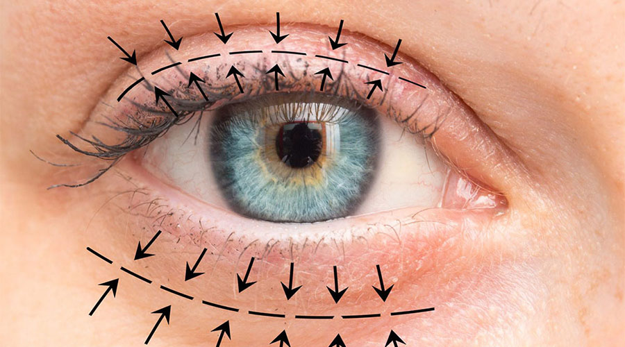 Oculoplasty and Eyelid Surgery